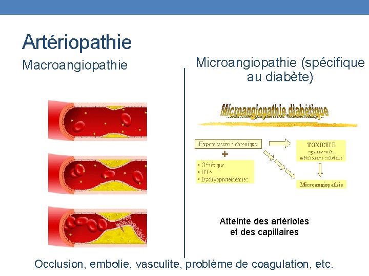 Artériopathie Macroangiopathie Microangiopathie (spécifique au diabète) Atteinte des artérioles et des capillaires Occlusion, embolie,