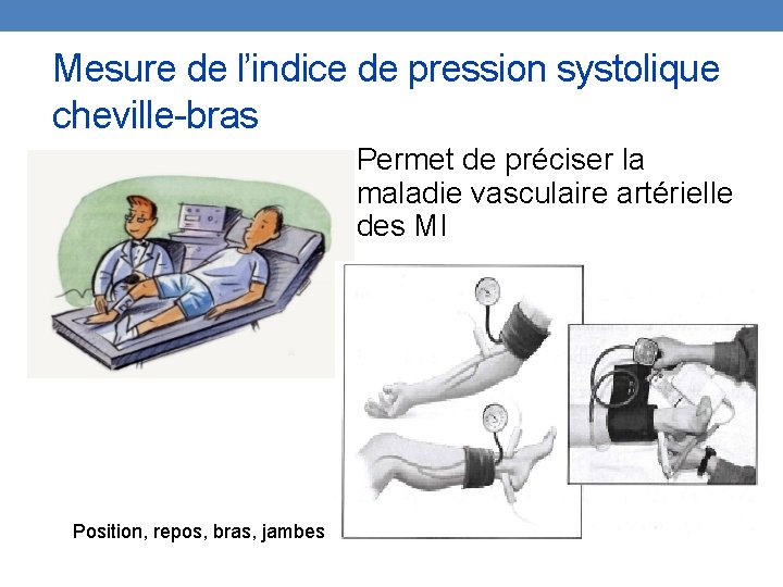 Mesure de l’indice de pression systolique cheville-bras Permet de préciser la maladie vasculaire artérielle