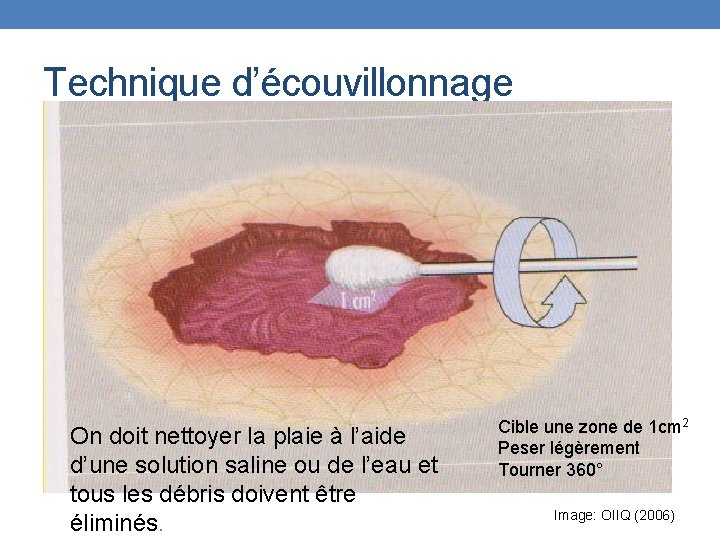 Technique d’écouvillonnage On doit nettoyer la plaie à l’aide d’une solution saline ou de