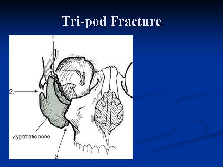 Tri-pod Fracture 