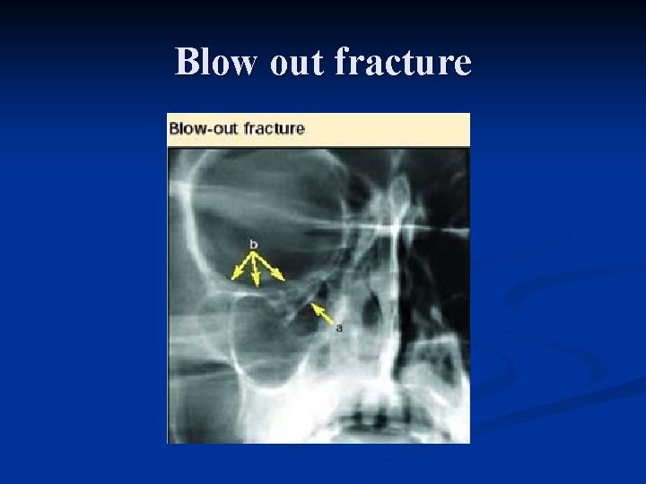 Blow out fracture 