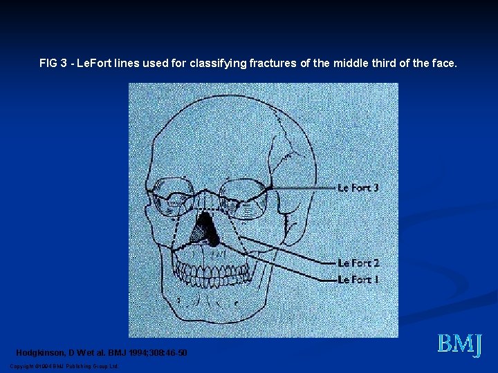 FIG 3 - Le. Fort lines used for classifying fractures of the middle third