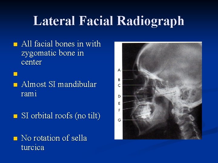 Lateral Facial Radiograph n All facial bones in with zygomatic bone in center n