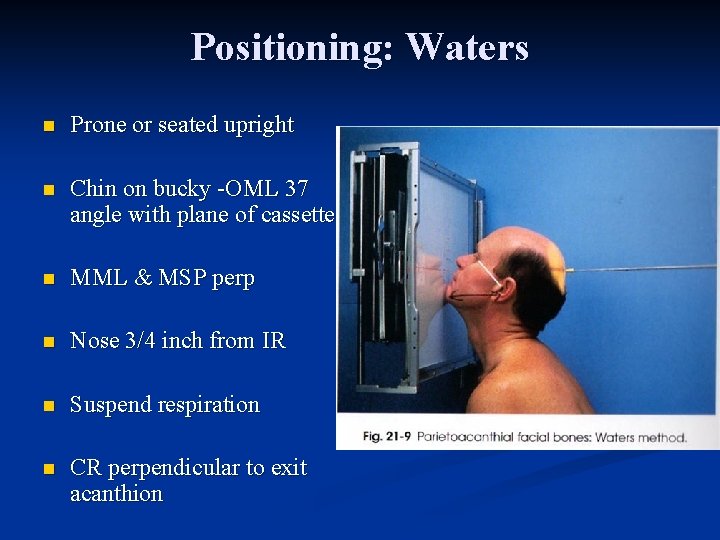 Positioning: Waters n Prone or seated upright n Chin on bucky -OML 37 angle