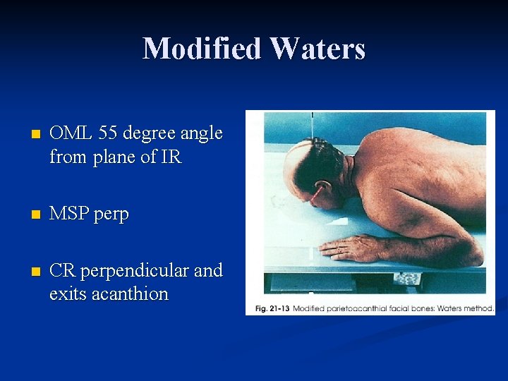 Modified Waters n OML 55 degree angle from plane of IR n MSP perp