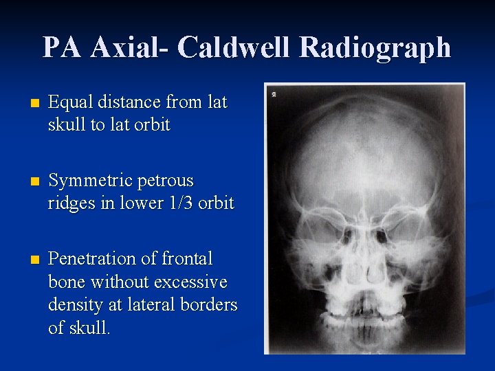 PA Axial- Caldwell Radiograph n Equal distance from lat skull to lat orbit n