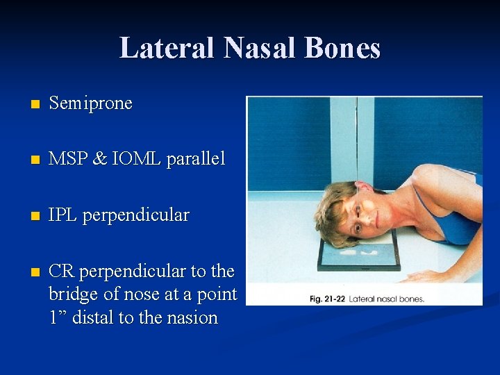 Lateral Nasal Bones n Semiprone n MSP & IOML parallel n IPL perpendicular n