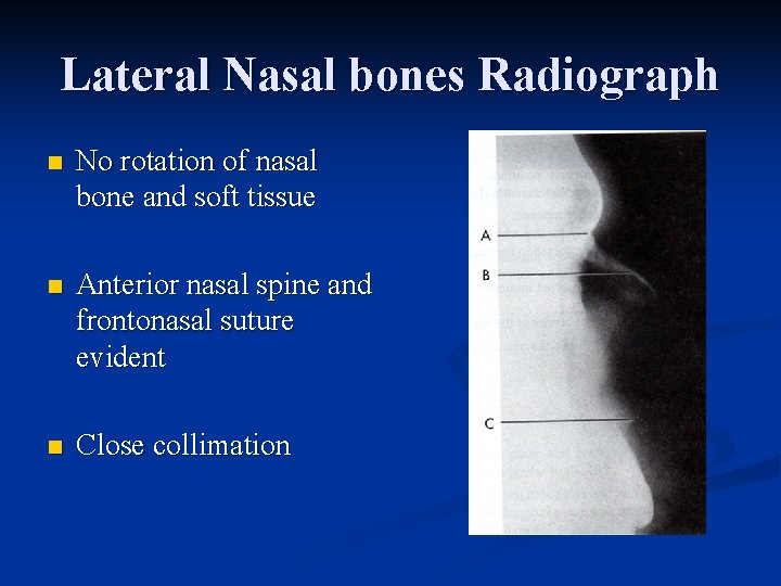 Lateral Nasal bones Radiograph n No rotation of nasal bone and soft tissue n