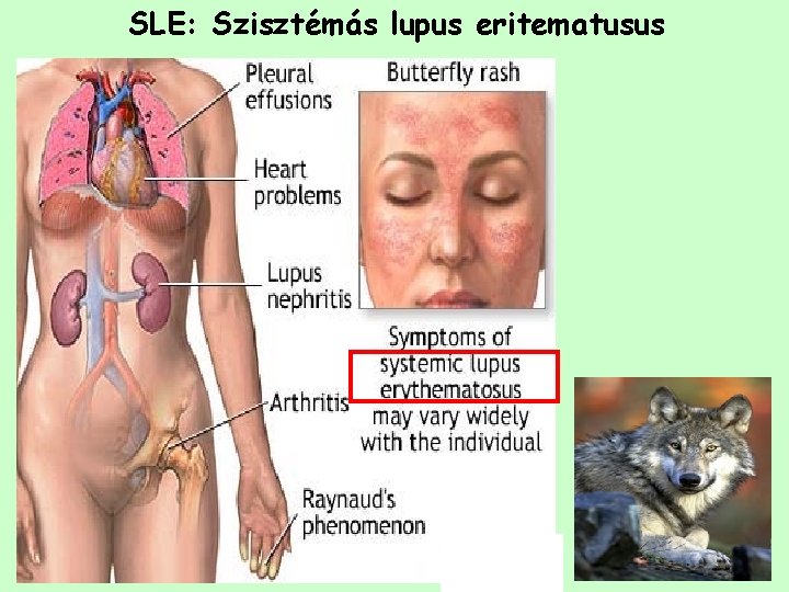 SLE: Szisztémás lupus eritematusus 