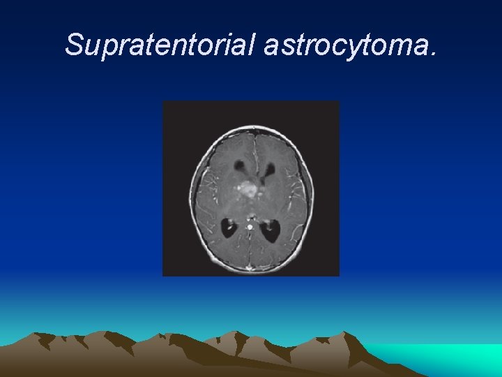 Supratentorial astrocytoma. 