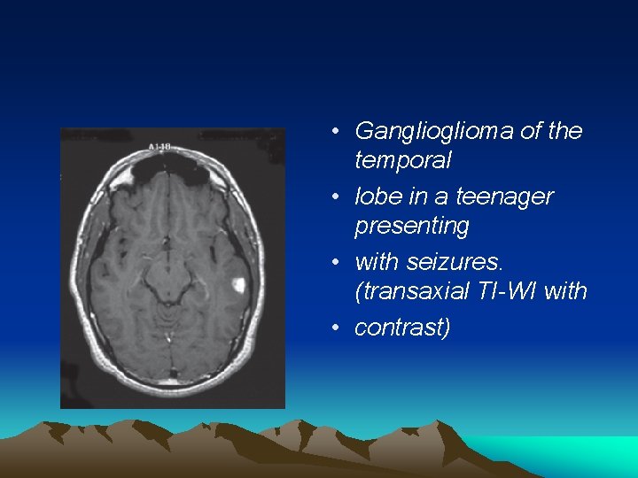  • Ganglioma of the temporal • lobe in a teenager presenting • with
