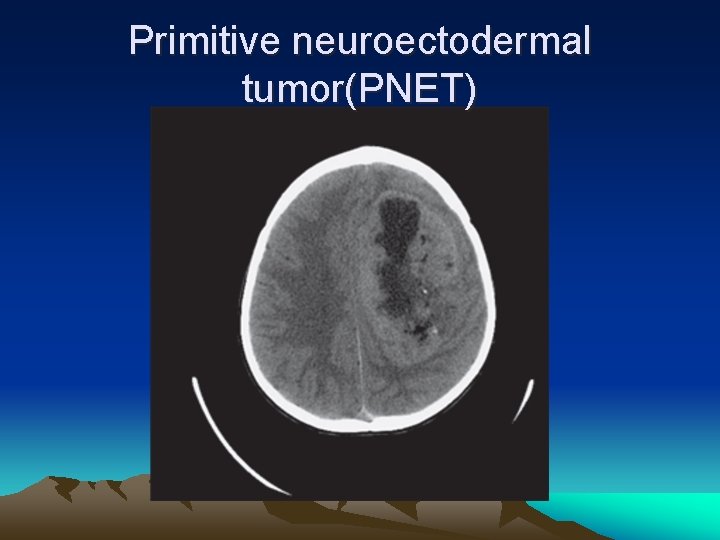 Primitive neuroectodermal tumor(PNET) 