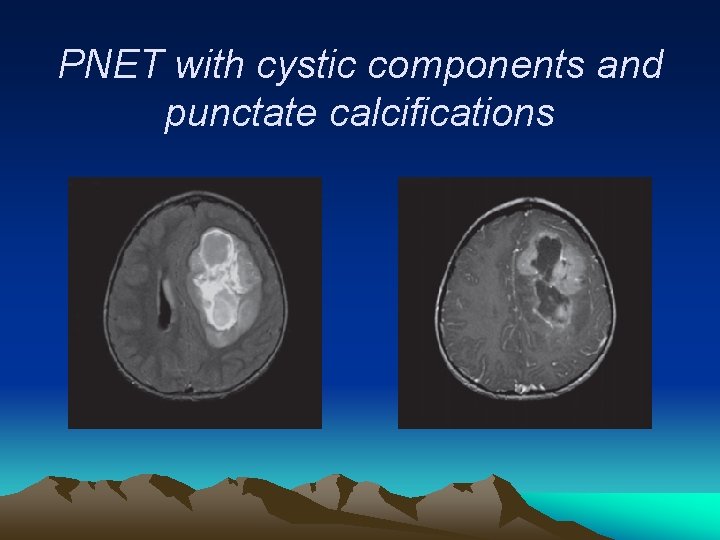 PNET with cystic components and punctate calcifications 