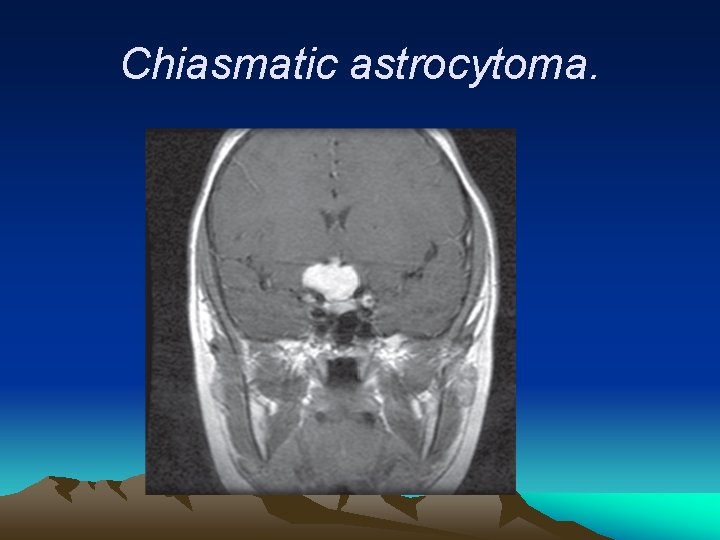 Chiasmatic astrocytoma. 