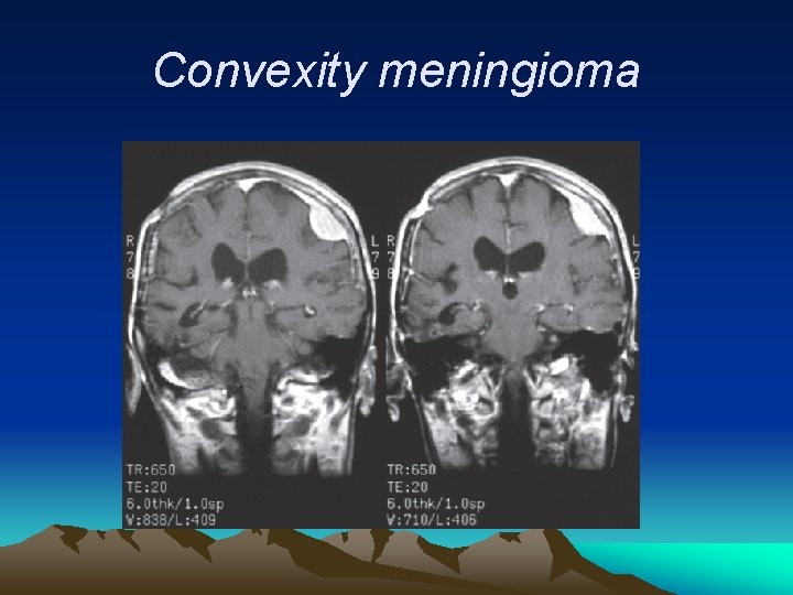 Convexity meningioma 
