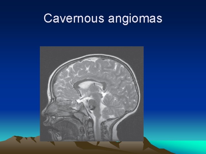 Cavernous angiomas 