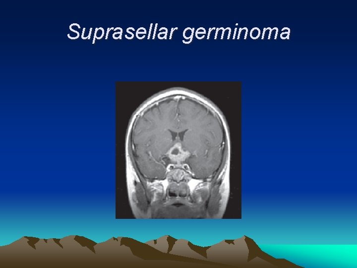Suprasellar germinoma 