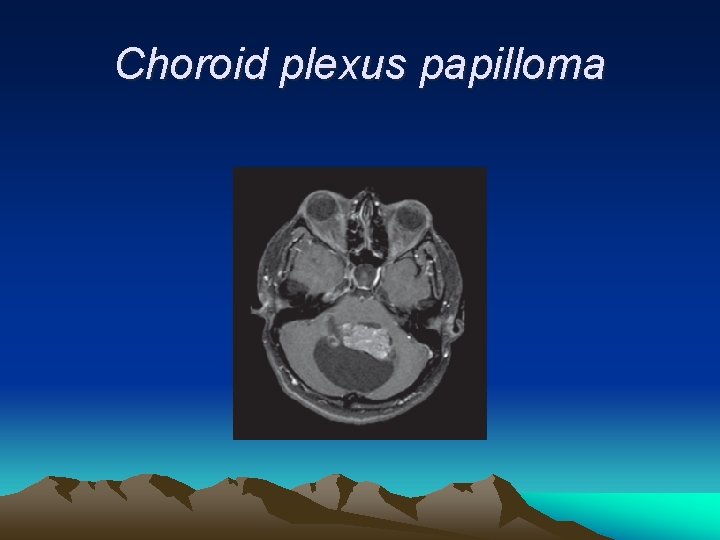 Choroid plexus papilloma 