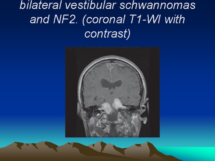 bilateral vestibular schwannomas and NF 2. (coronal T 1 -WI with contrast) 