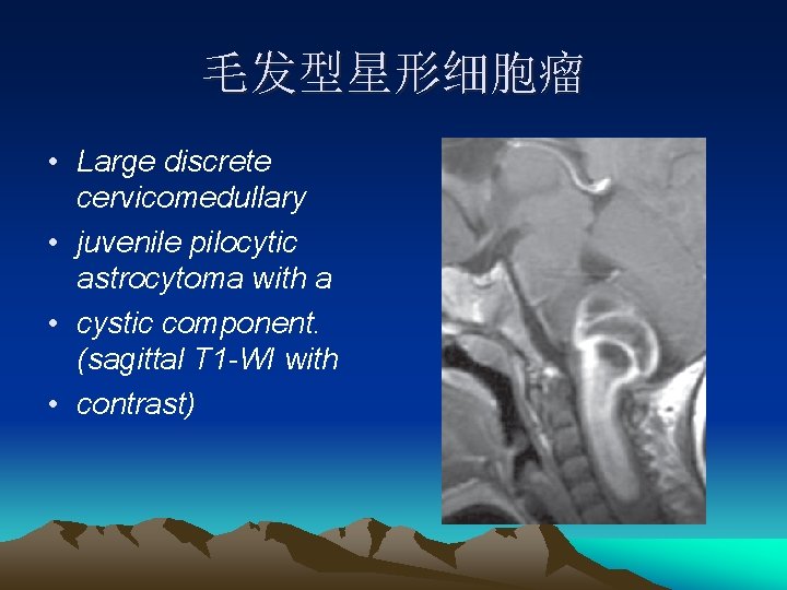 毛发型星形细胞瘤 • Large discrete cervicomedullary • juvenile pilocytic astrocytoma with a • cystic component.