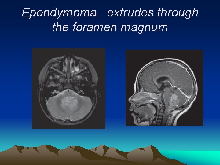 Ependymoma. extrudes through the foramen magnum 