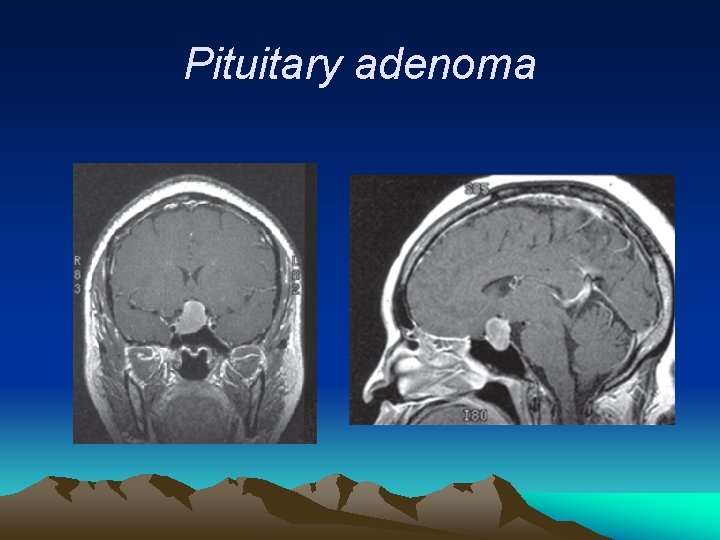 Pituitary adenoma 