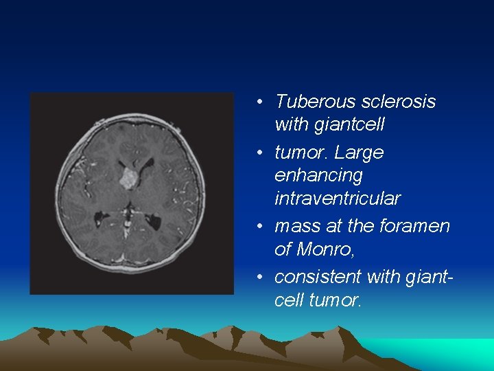  • Tuberous sclerosis with giantcell • tumor. Large enhancing intraventricular • mass at