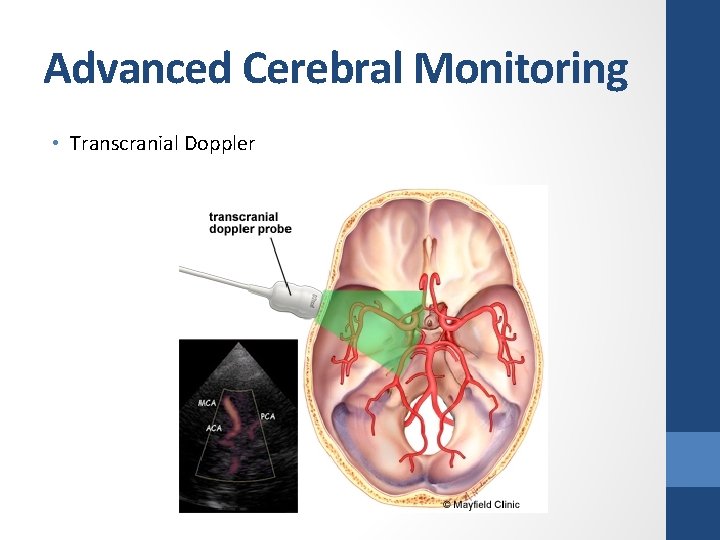 Advanced Cerebral Monitoring • Transcranial Doppler 