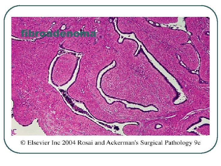 fibroadenoma 