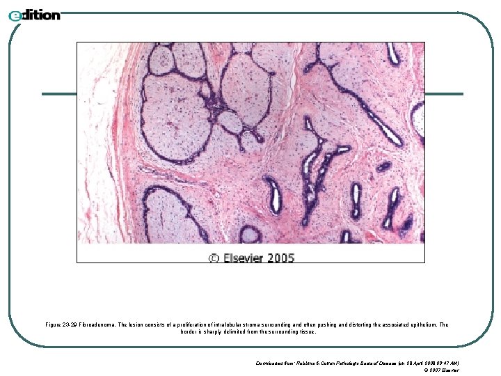 Figure 23 -29 Fibroadenoma. The lesion consists of a proliferation of intralobular stroma surrounding