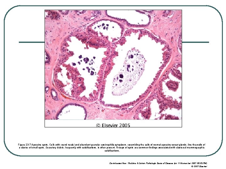 Figure 23 -7 Apocrine cysts. Cells with round nuclei and abundant granular eosinophilic cytoplasm,