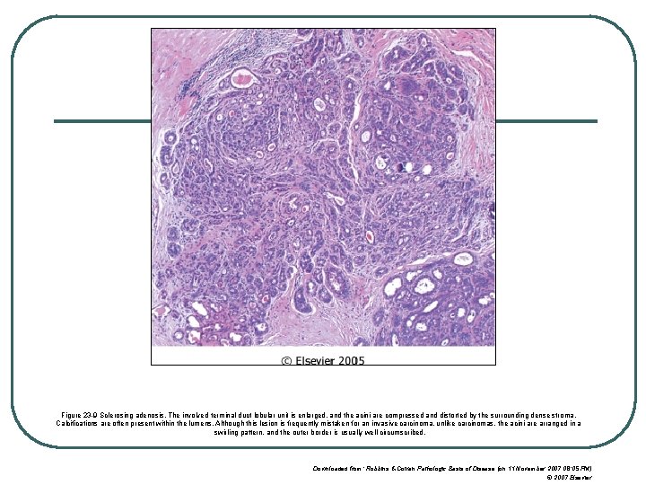 Figure 23 -9 Sclerosing adenosis. The involved terminal duct lobular unit is enlarged, and