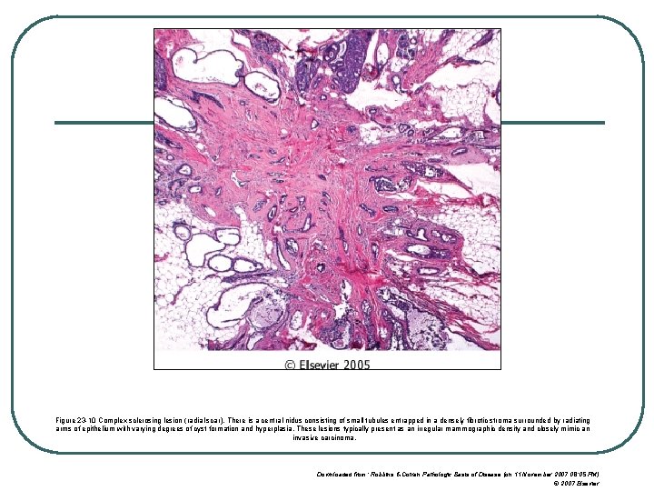 Figure 23 -10 Complex sclerosing lesion (radial scar). There is a central nidus consisting