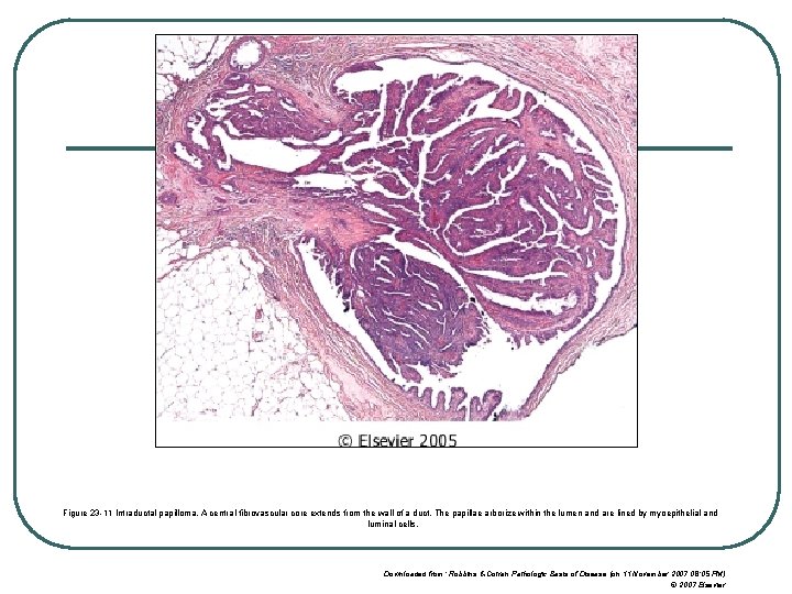Figure 23 -11 Intraductal papilloma. A central fibrovascular core extends from the wall of