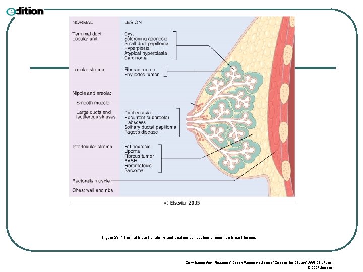 Figure 23 -1 Normal breast anatomy and anatomical location of common breast lesions. Downloaded