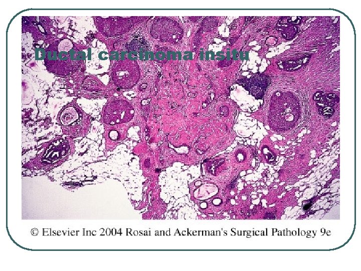 Ductal carcinoma insitu 