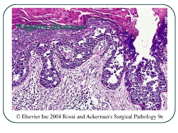 Pagets disease 