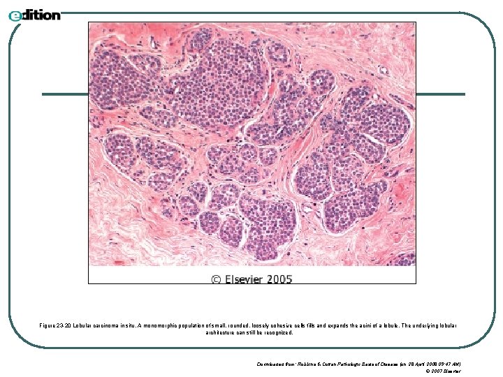Figure 23 -20 Lobular carcinoma in situ. A monomorphic population of small, rounded, loosely