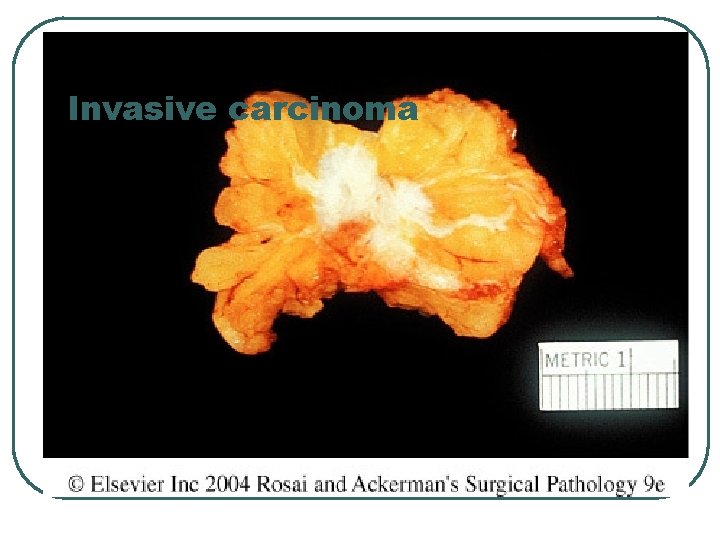 Invasive carcinoma 