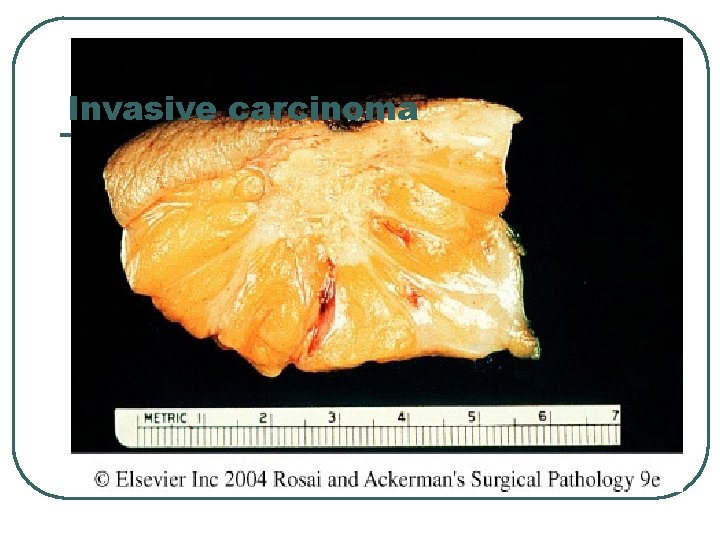 Invasive carcinoma 