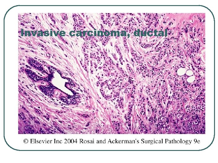 Invasive carcinoma, ductal 