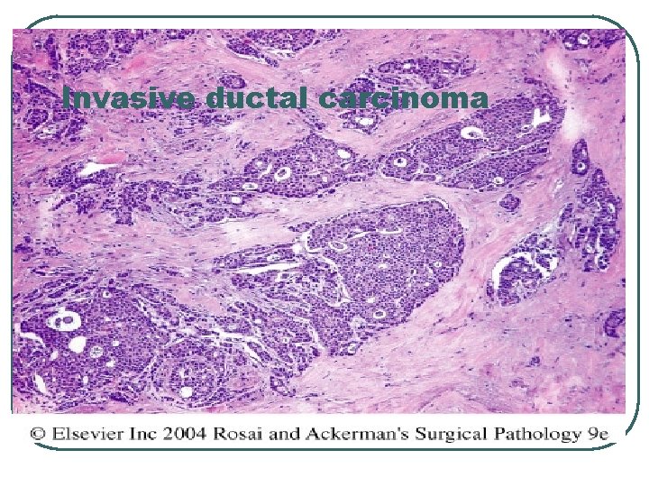 Invasive ductal carcinoma 