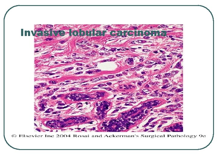 Invasive lobular carcinoma 