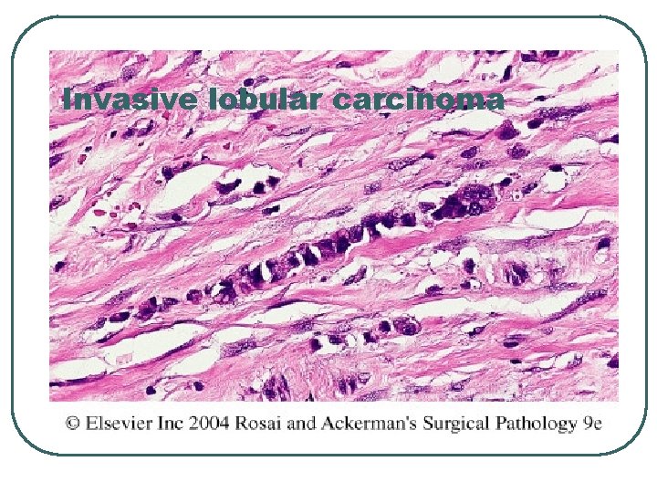 Invasive lobular carcinoma 