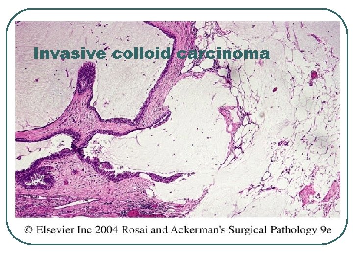 Invasive colloid carcinoma 