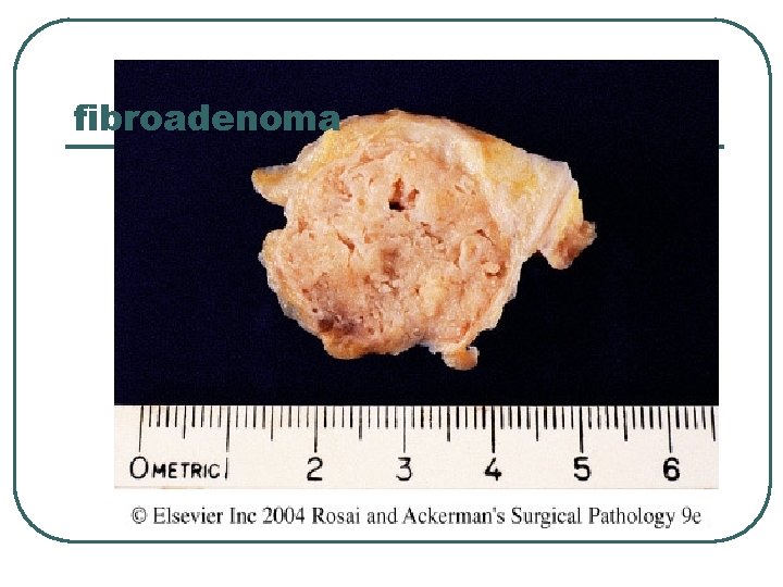 fibroadenoma 