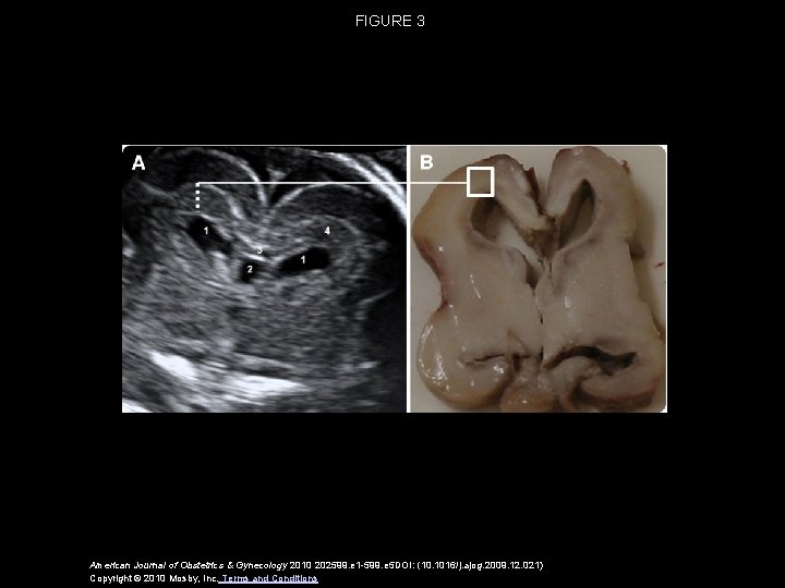 FIGURE 3 American Journal of Obstetrics & Gynecology 2010 202599. e 1 -599. e