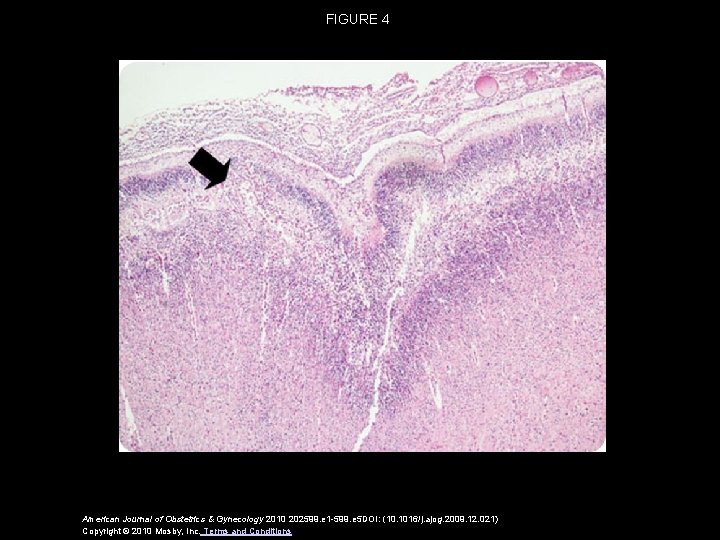 FIGURE 4 American Journal of Obstetrics & Gynecology 2010 202599. e 1 -599. e