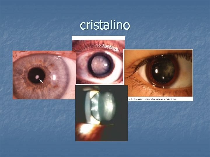 cristalino 