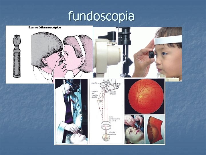 fundoscopia 